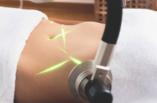 Exploring Laser Body Sculpting Techniques